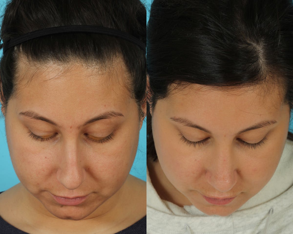 Rhinoplasty Before & After Gallery - Patient 166017 - Image 3