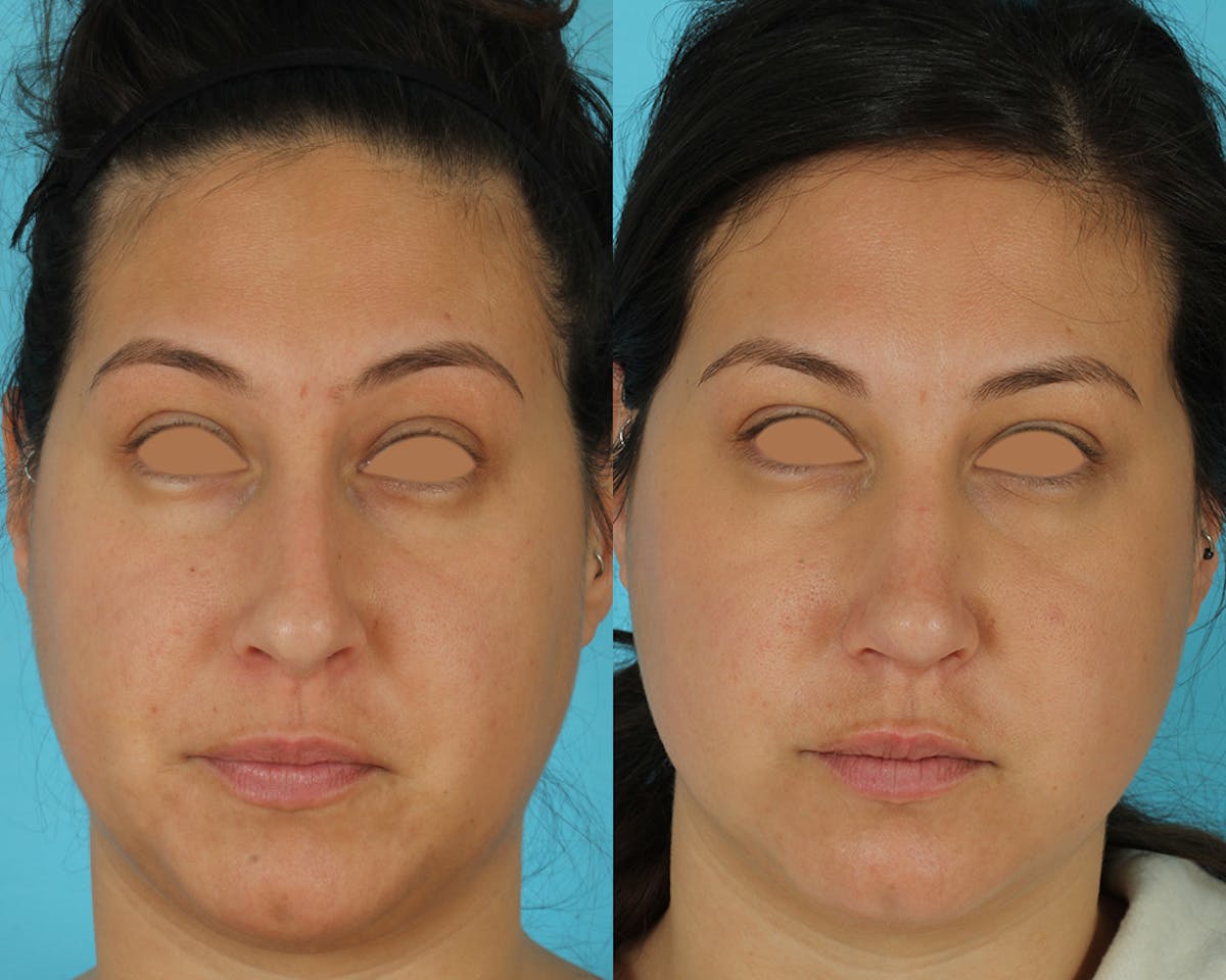 Rhinoplasty Before & After Gallery - Patient 166017 - Image 4