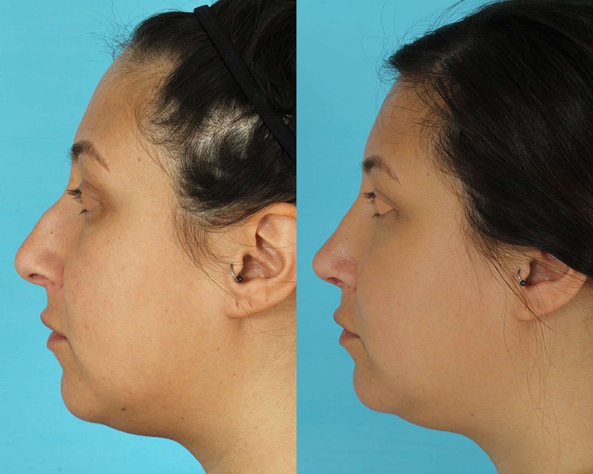 Rhinoplasty Before & After Gallery - Patient 166017 - Image 5