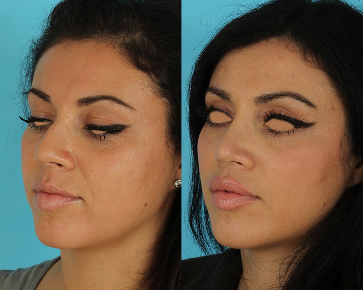Rhinoplasty Before & After Gallery - Patient 127860 - Image 1
