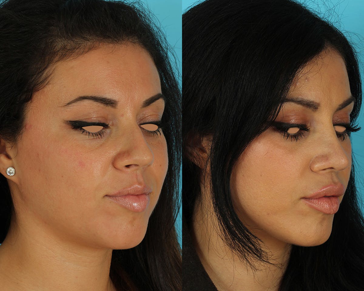 Rhinoplasty Before & After Gallery - Patient 127860 - Image 2