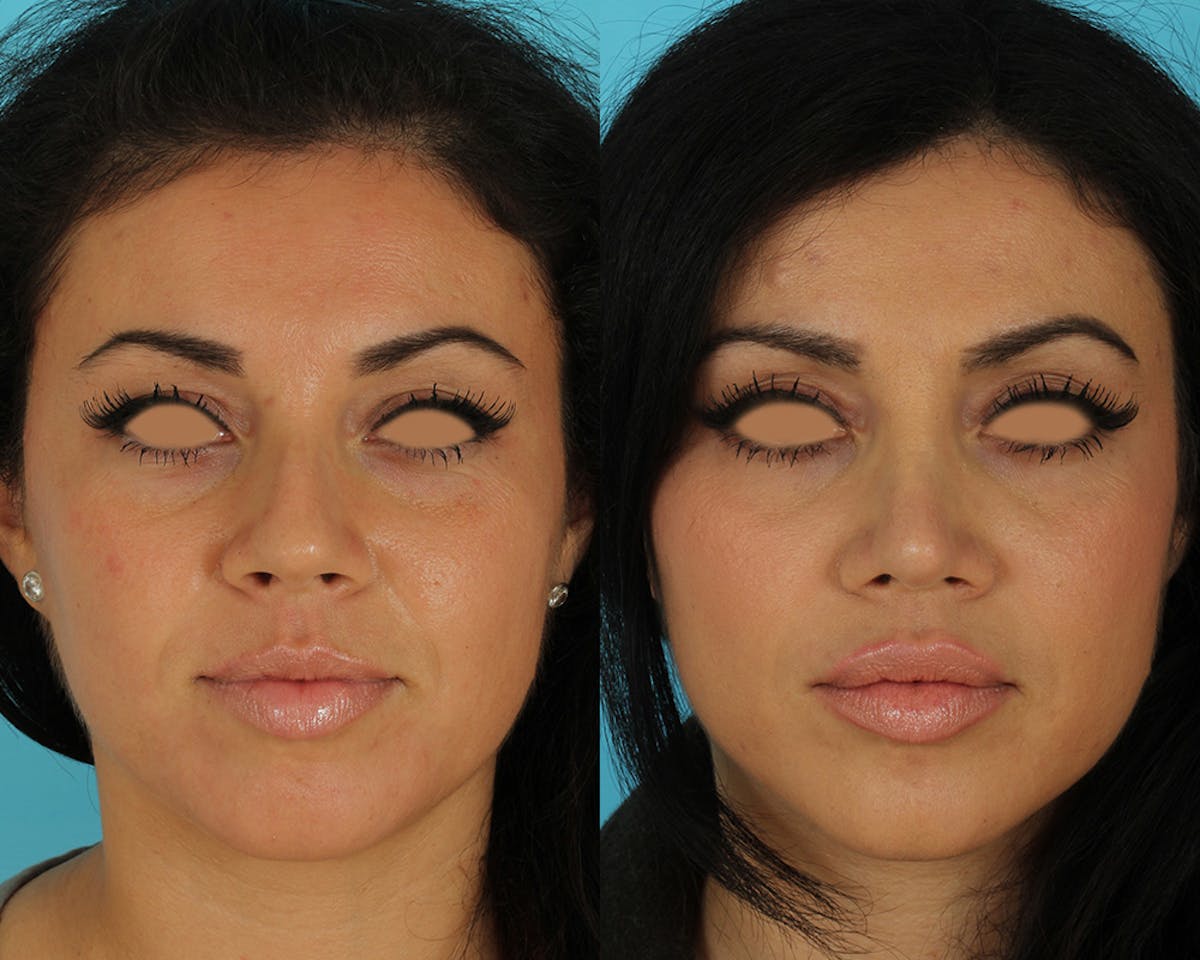 Rhinoplasty Before & After Gallery - Patient 127860 - Image 3
