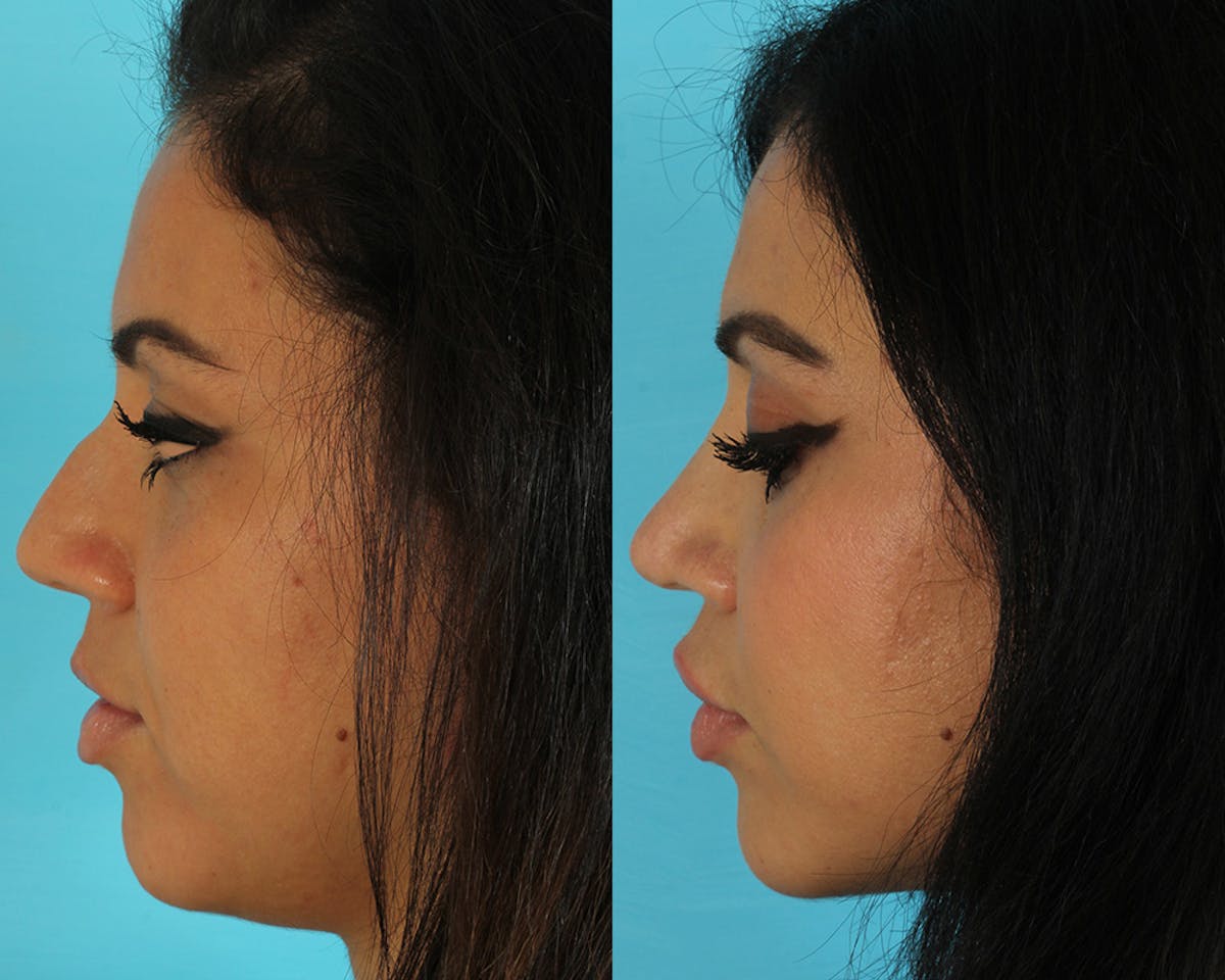 Rhinoplasty Before & After Gallery - Patient 127860 - Image 4