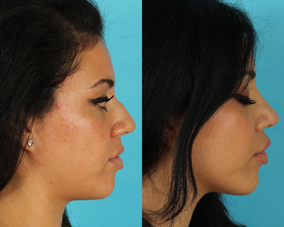 Rhinoplasty Before & After Gallery - Patient 127860 - Image 5
