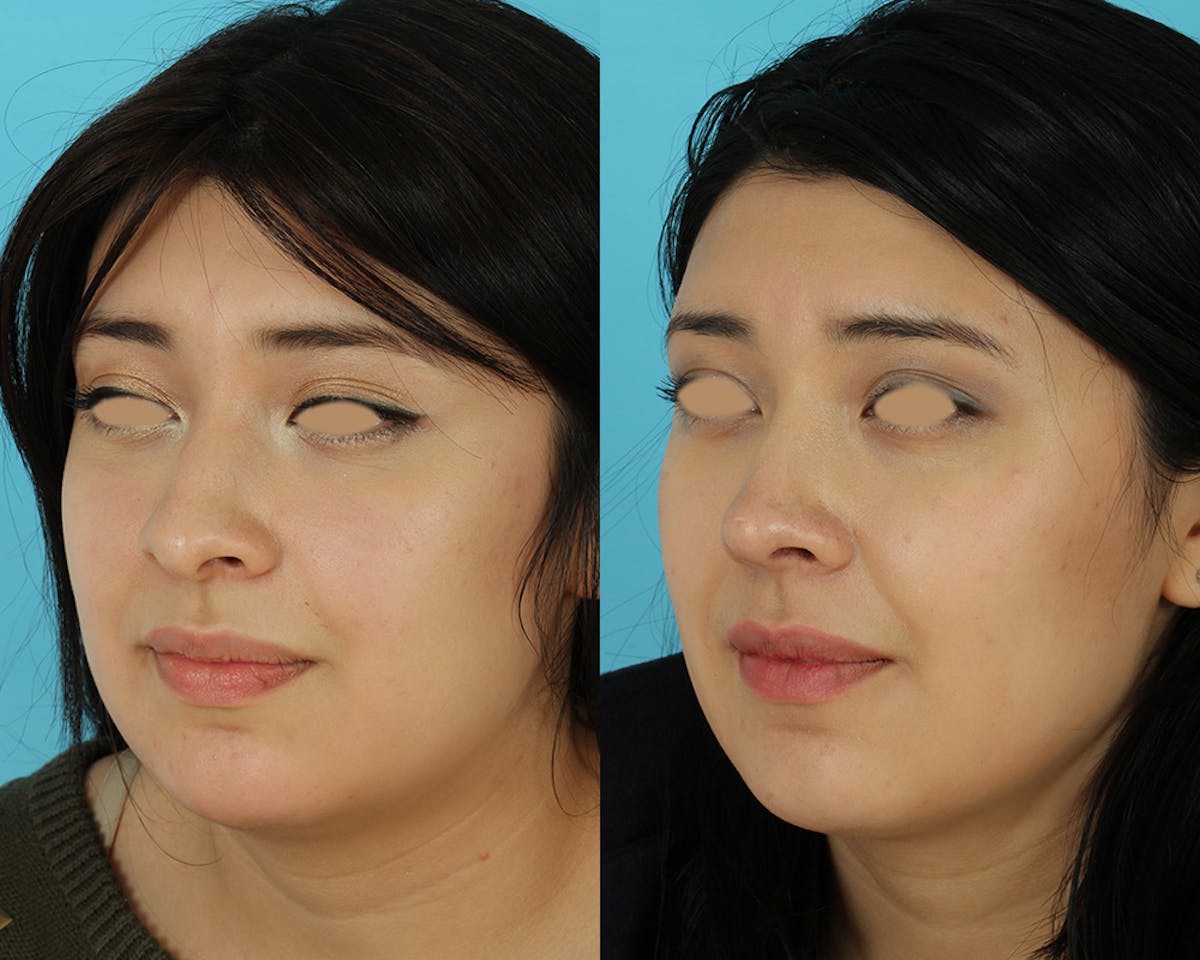 Rhinoplasty Before & After Gallery - Patient 207777 - Image 1