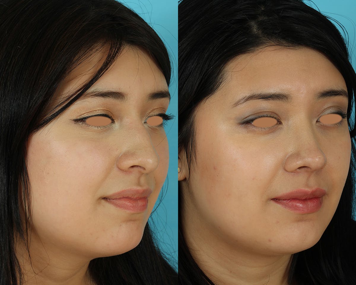 Rhinoplasty Before & After Gallery - Patient 207777 - Image 2