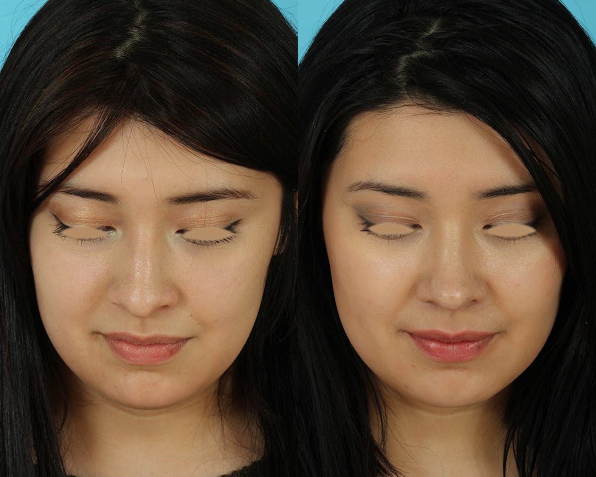 Rhinoplasty Before & After Gallery - Patient 207777 - Image 3