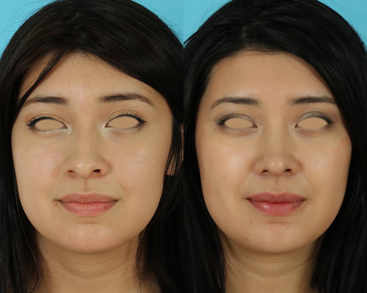 Rhinoplasty Before & After Gallery - Patient 207777 - Image 4