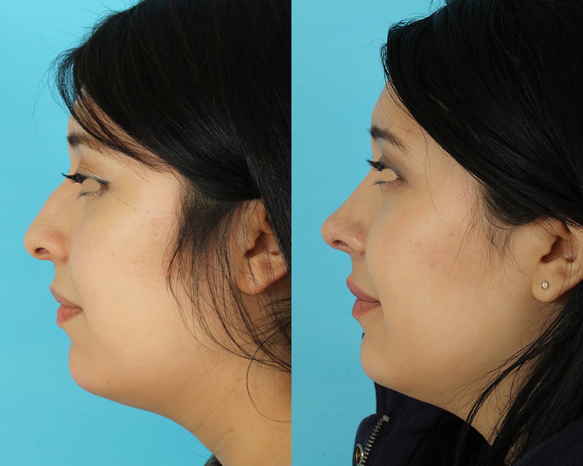 Rhinoplasty Before & After Gallery - Patient 207777 - Image 5
