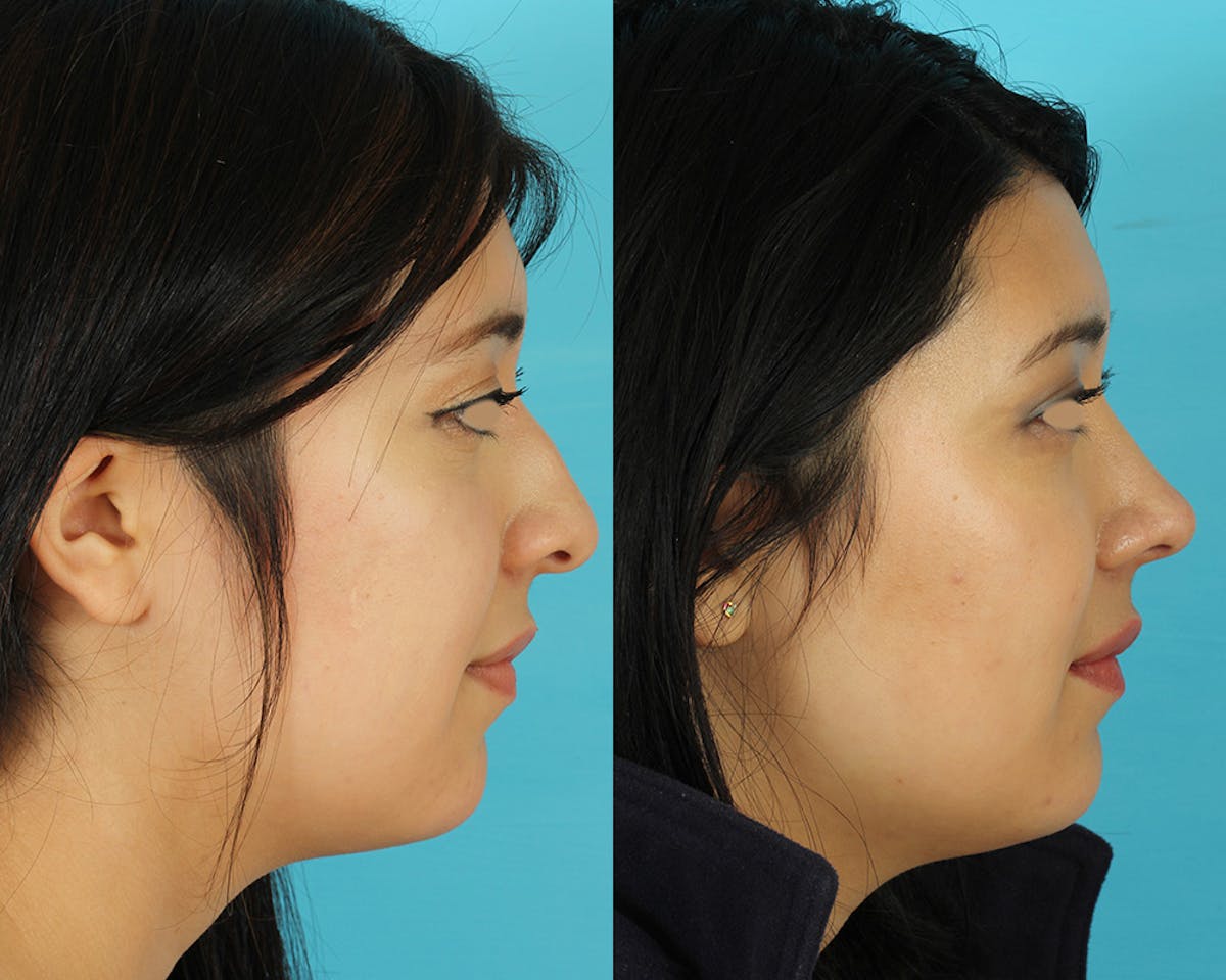Rhinoplasty Before & After Gallery - Patient 207777 - Image 6