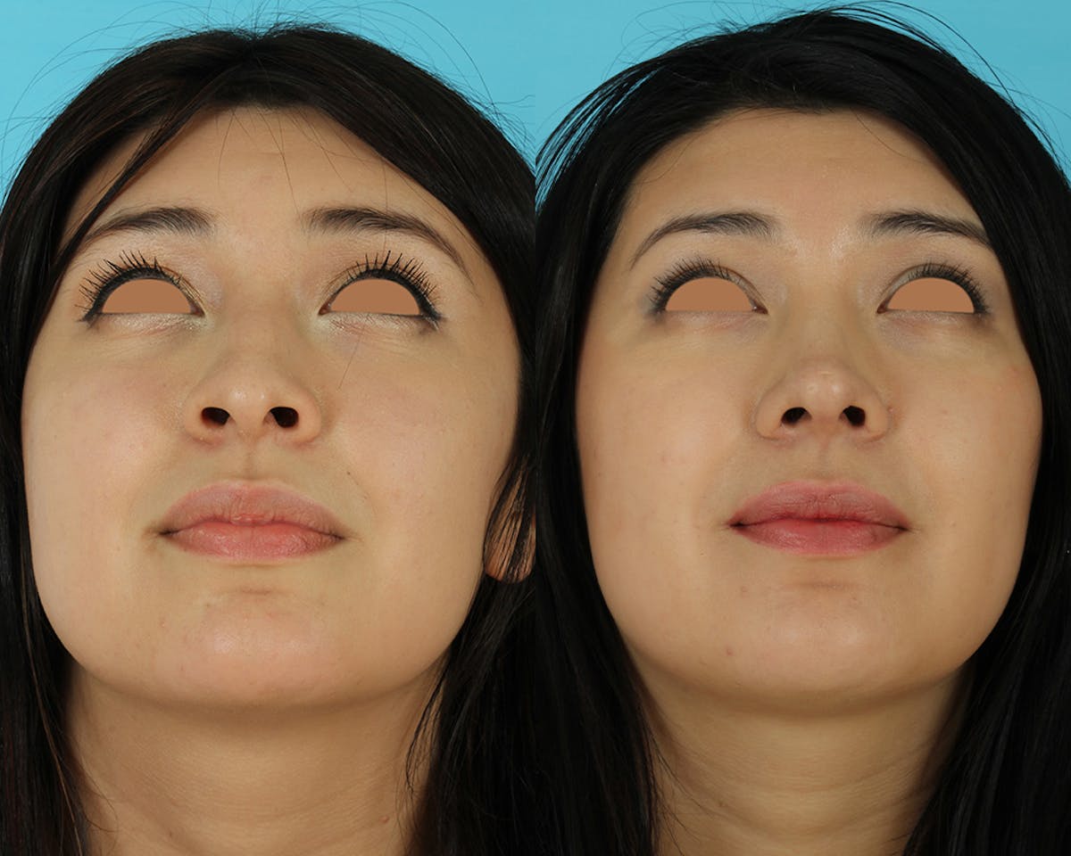 Rhinoplasty Before & After Gallery - Patient 207777 - Image 7
