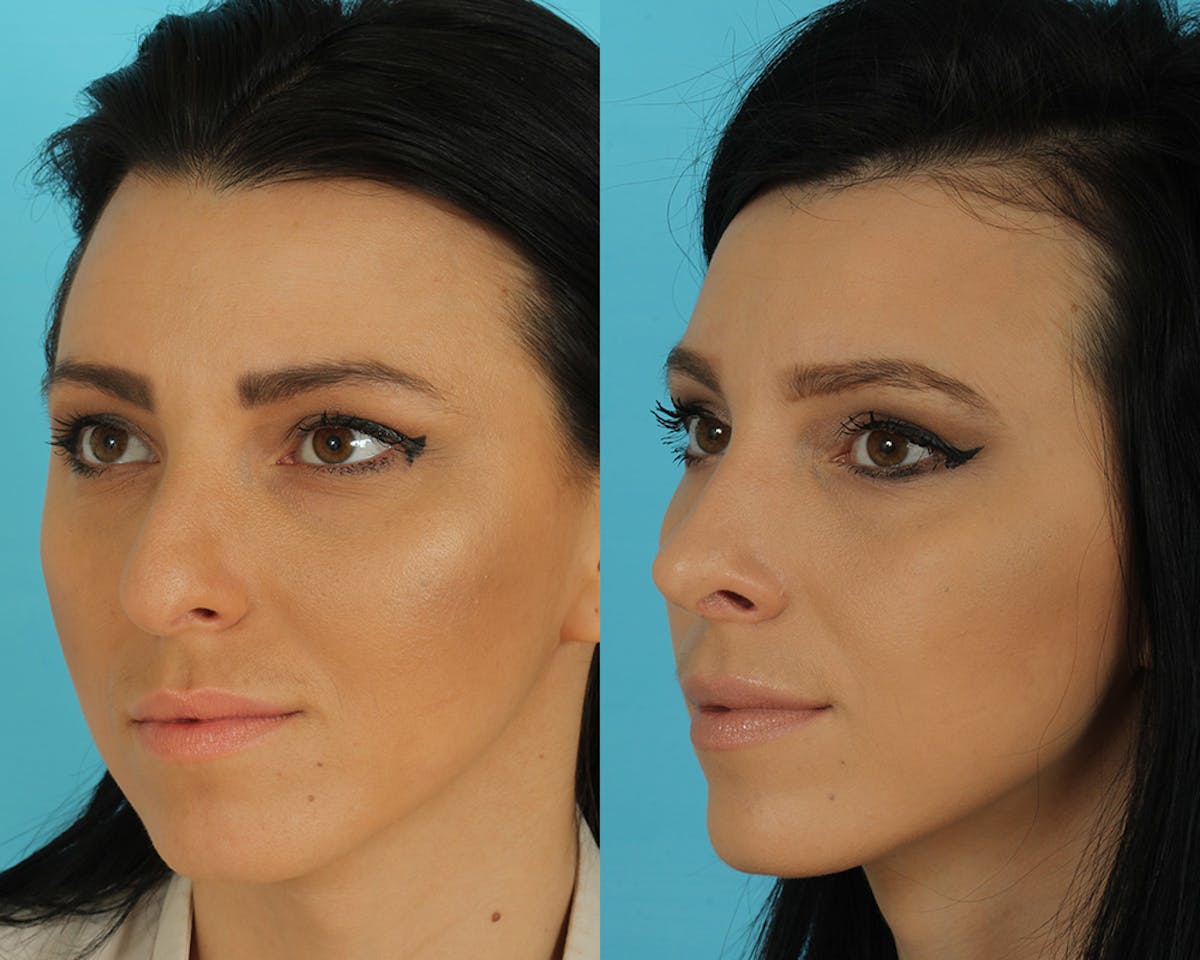 Rhinoplasty Before & After Gallery - Patient 492889 - Image 1