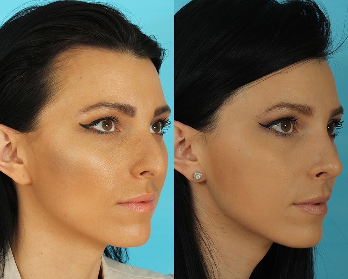 Rhinoplasty Before & After Gallery - Patient 492889 - Image 2