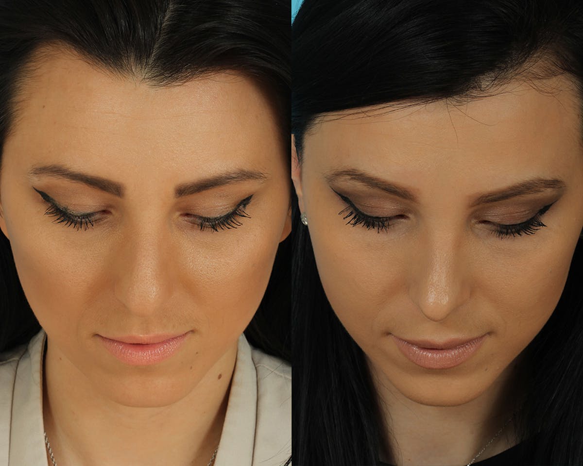 Rhinoplasty Before & After Gallery - Patient 492889 - Image 3