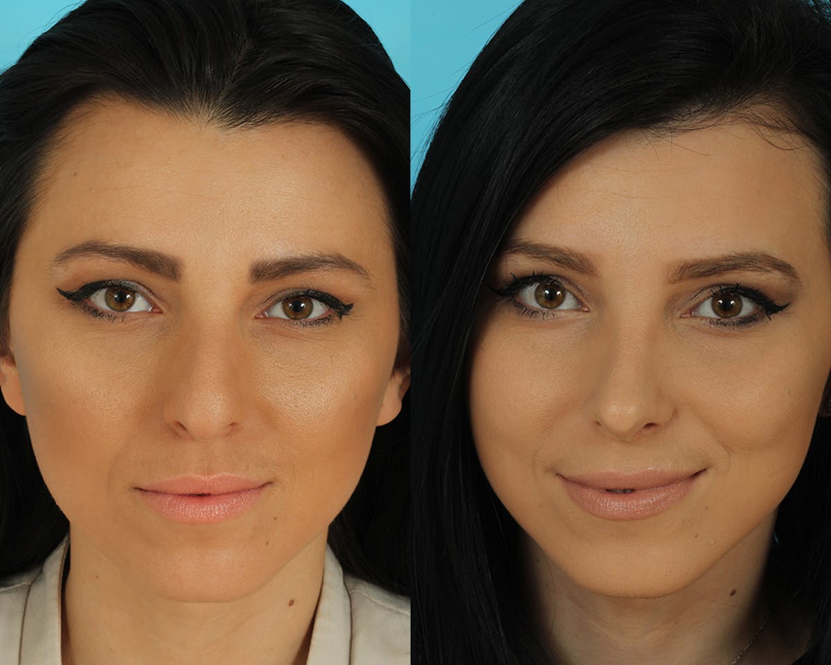 Rhinoplasty Before & After Gallery - Patient 492889 - Image 4
