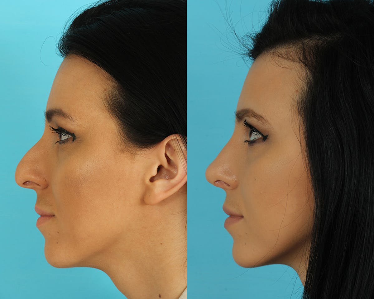Rhinoplasty Before & After Gallery - Patient 492889 - Image 5