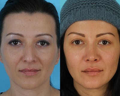 Rhinoplasty Before & After Gallery - Patient 356266 - Image 1