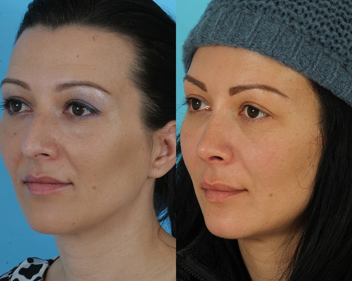 Rhinoplasty Before & After Gallery - Patient 356266 - Image 2