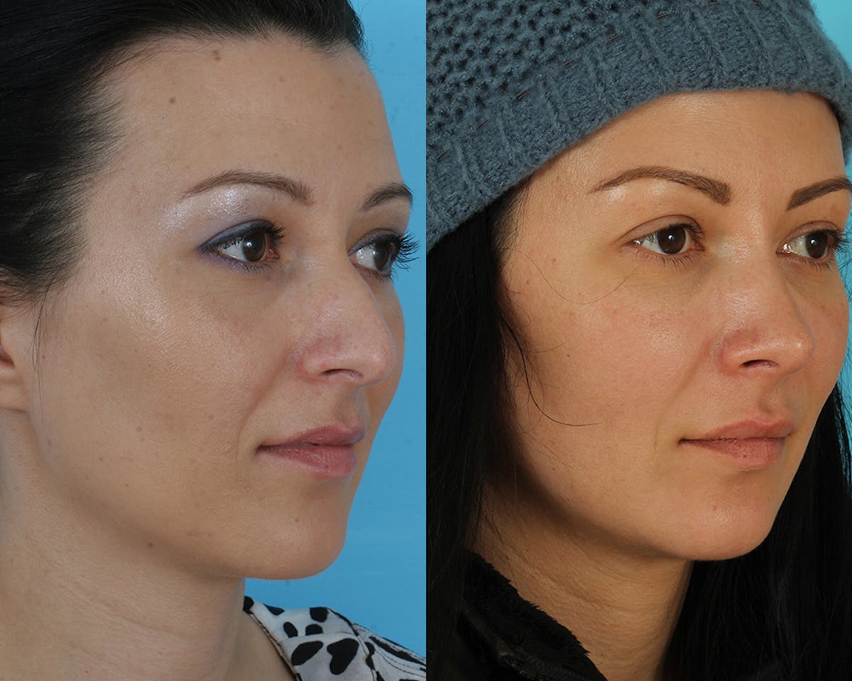 Rhinoplasty Before & After Gallery - Patient 356266 - Image 3