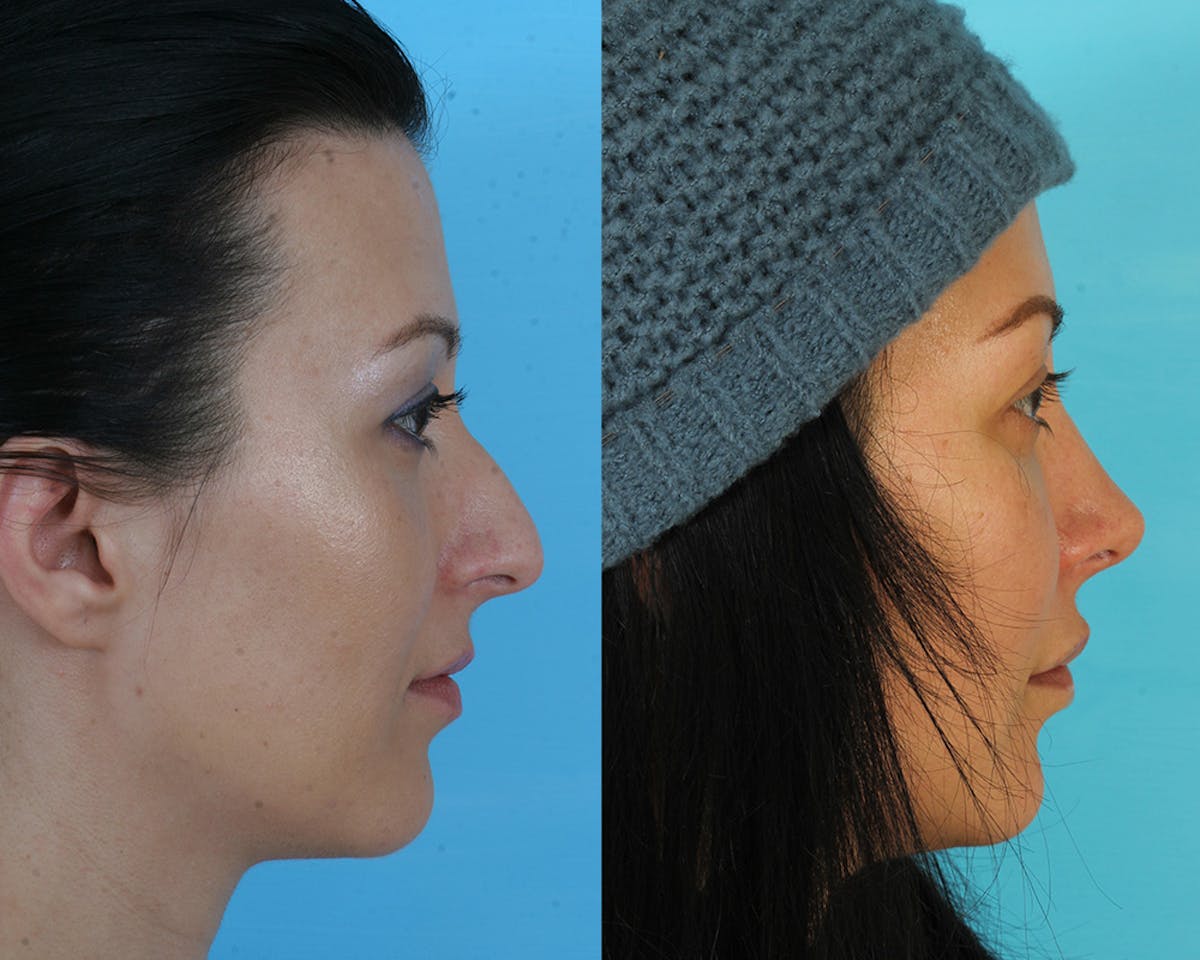 Rhinoplasty Before & After Gallery - Patient 356266 - Image 4