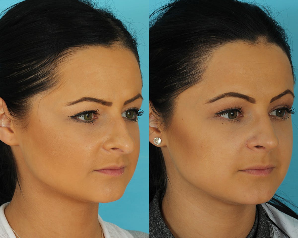Rhinoplasty Before & After Gallery - Patient 297450 - Image 2