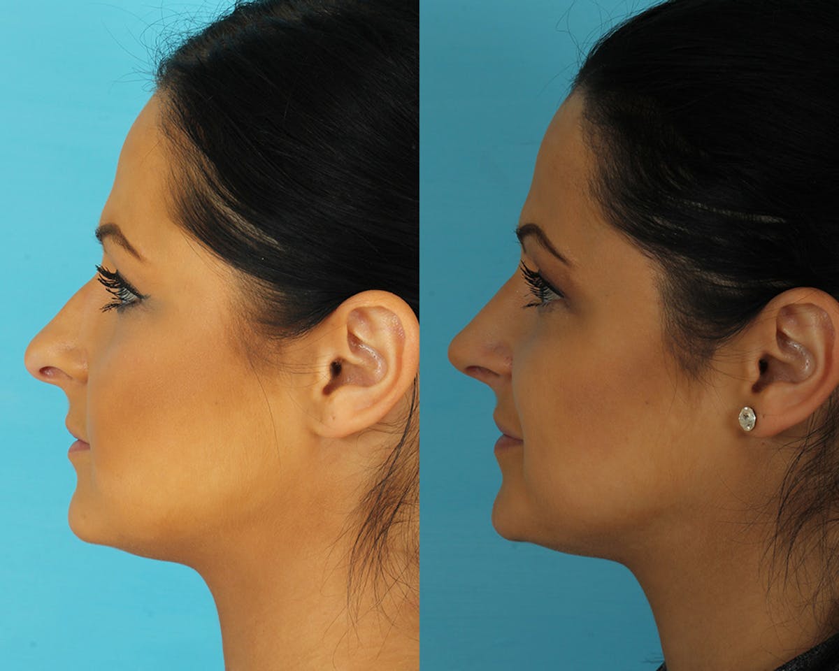 Rhinoplasty Before & After Gallery - Patient 297450 - Image 4