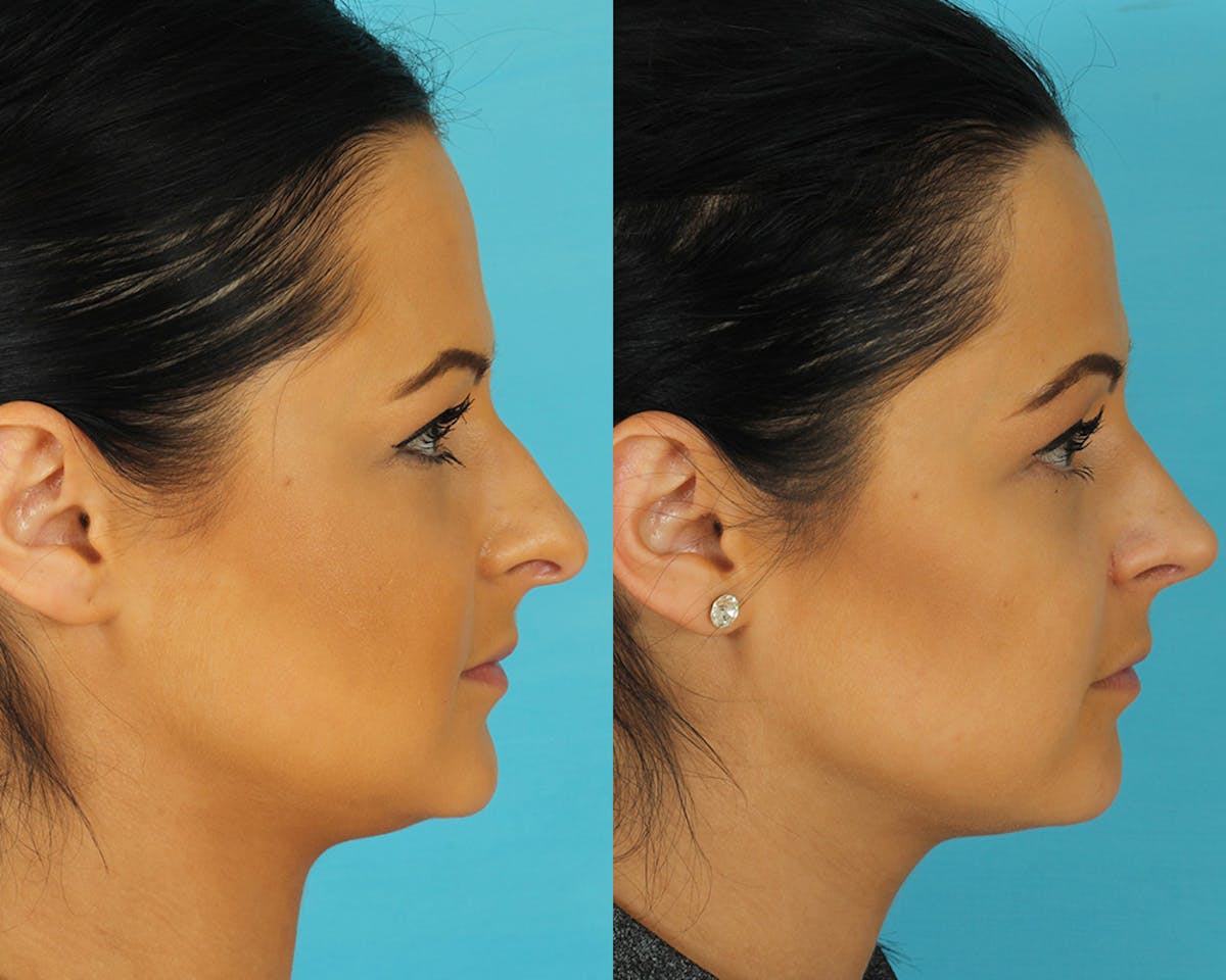 Rhinoplasty Before & After Gallery - Patient 297450 - Image 5