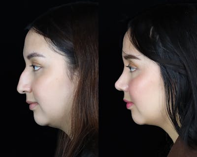 Rhinoplasty Before & After Gallery - Patient 395463 - Image 1