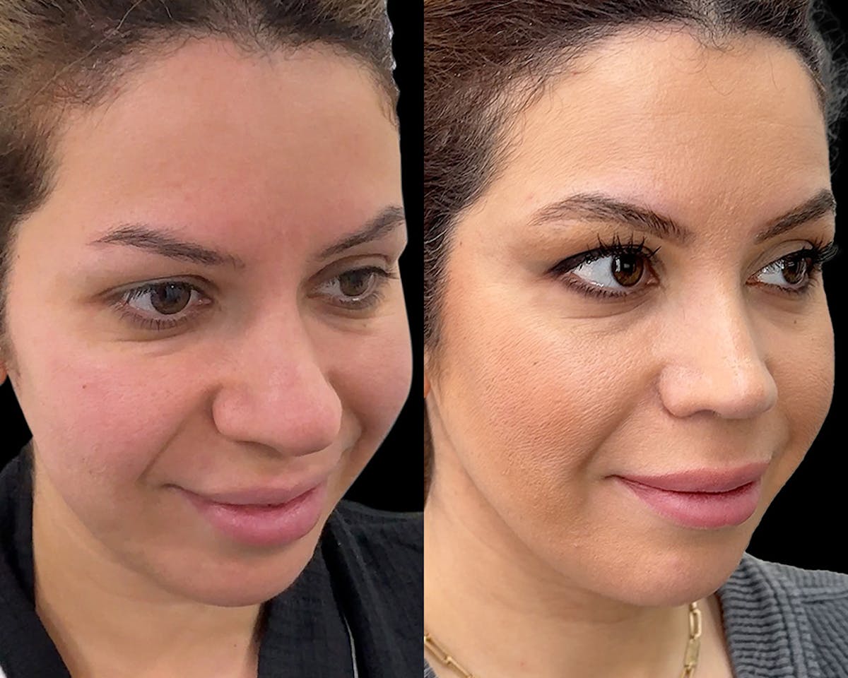 Rhinoplasty Before & After Gallery - Patient 343409 - Image 1