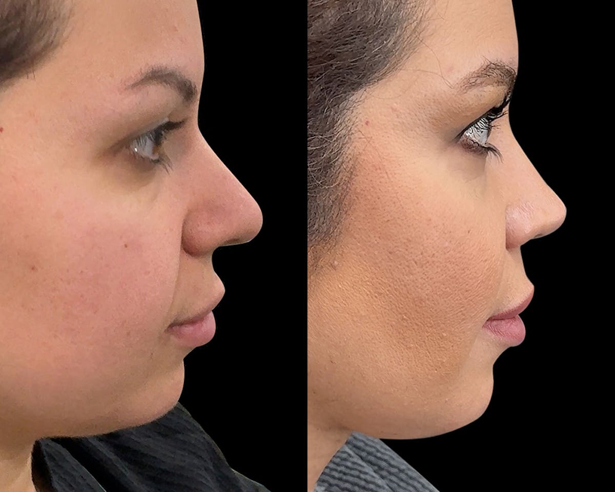 Rhinoplasty Before & After Gallery - Patient 343409 - Image 3
