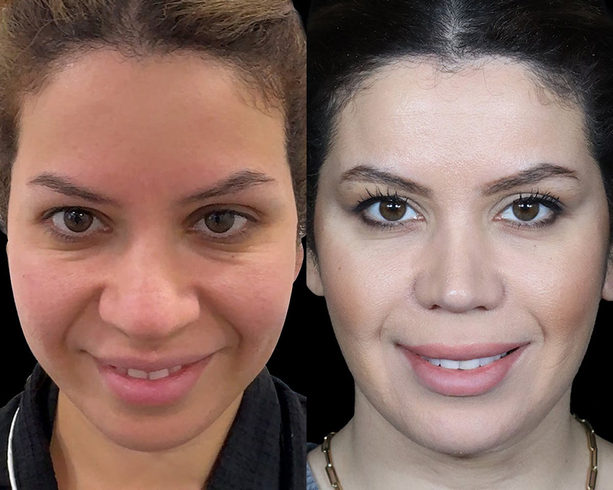 Rhinoplasty Before & After Gallery - Patient 343409 - Image 2