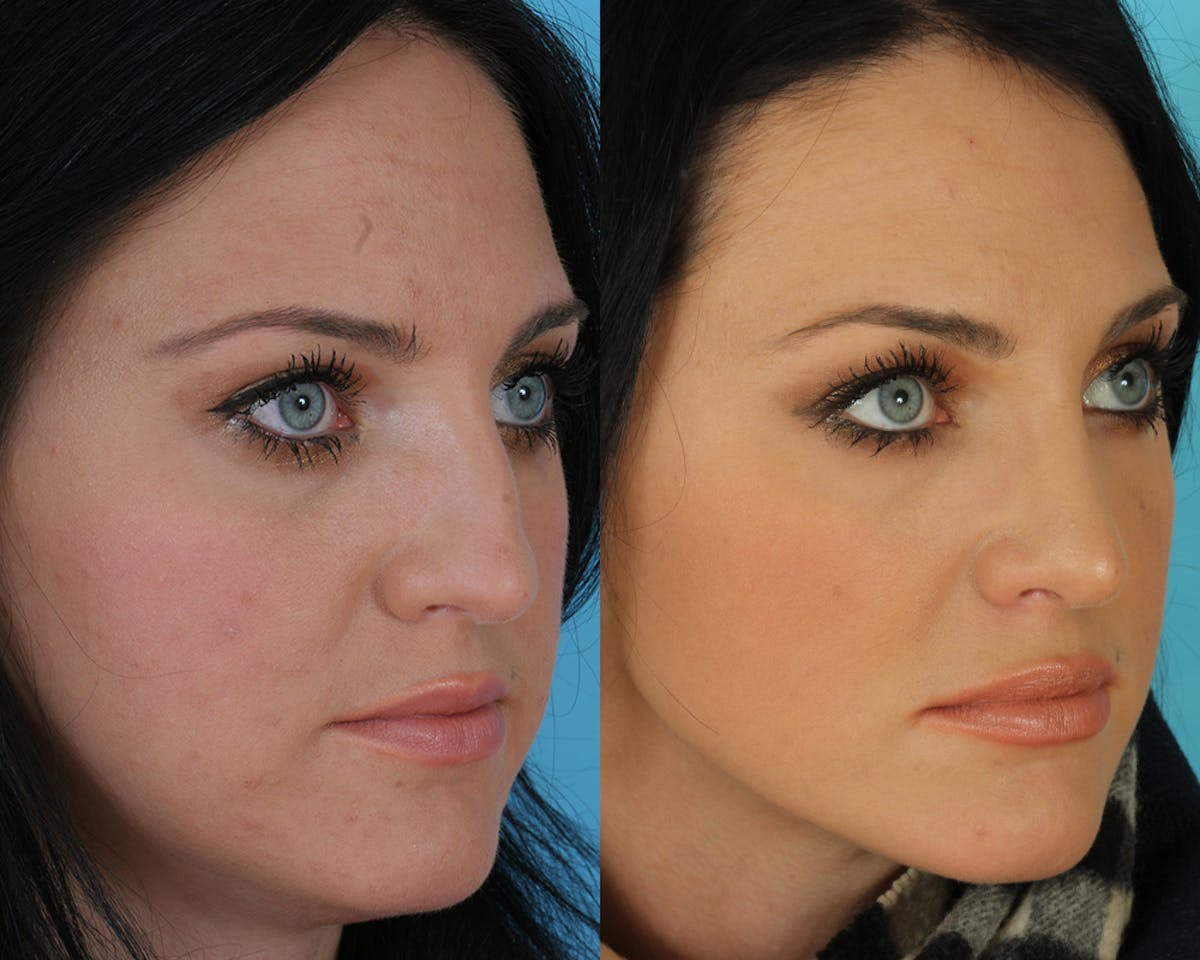 Rhinoplasty Before & After Gallery - Patient 142271 - Image 1