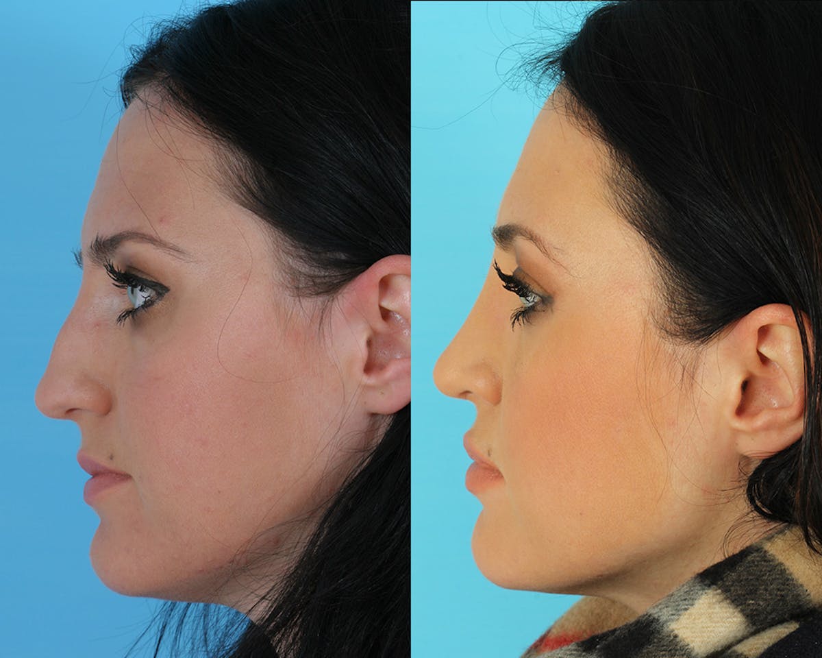 Rhinoplasty Before & After Gallery - Patient 142271 - Image 3