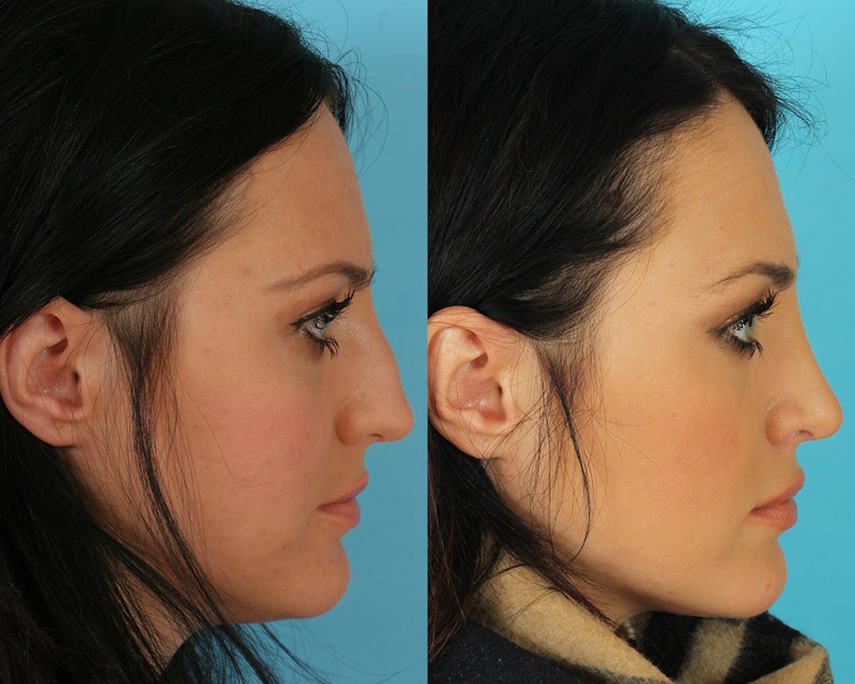 Rhinoplasty Before & After Gallery - Patient 142271 - Image 4