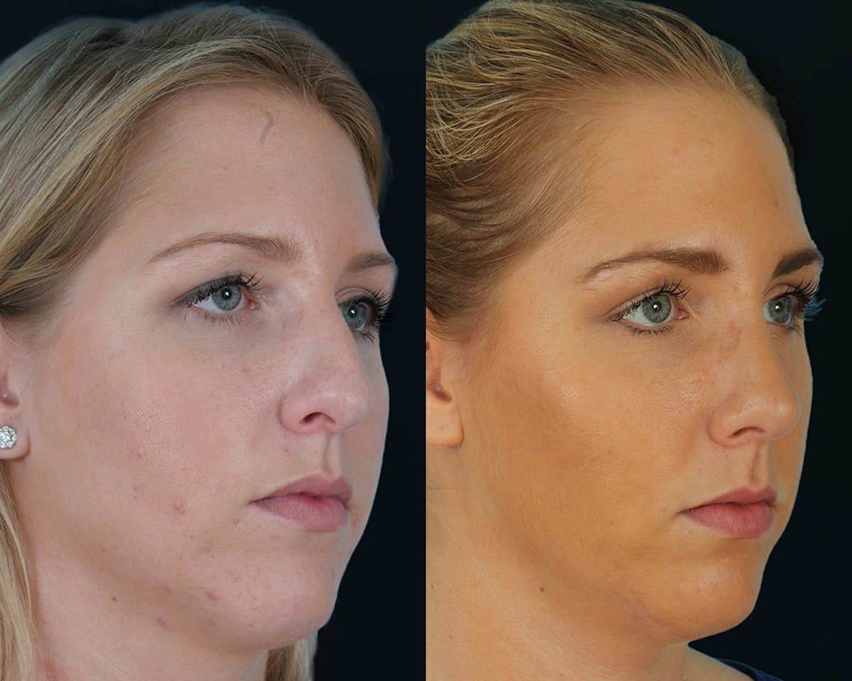Rhinoplasty Before & After Gallery - Patient 403995 - Image 1