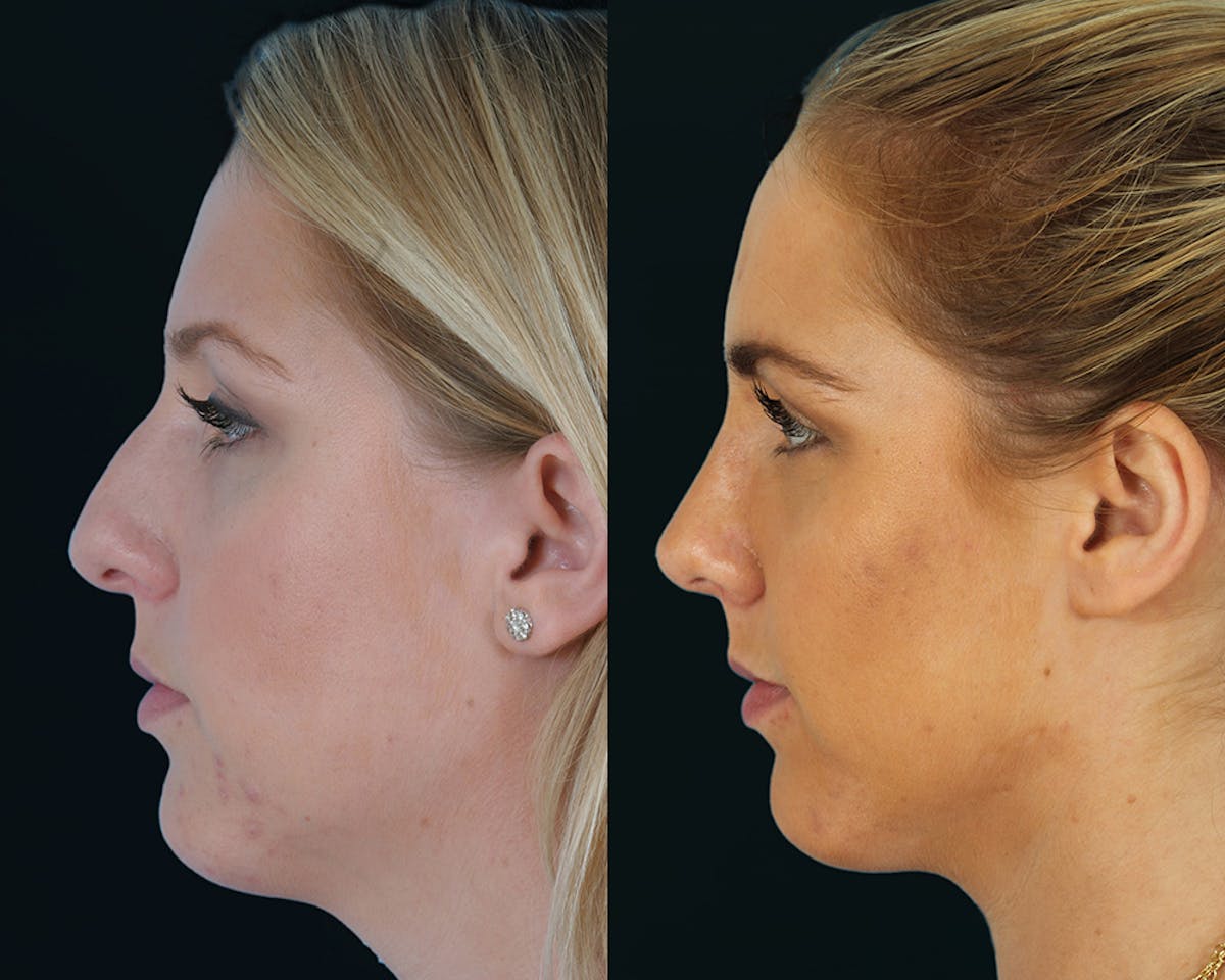 Rhinoplasty Before & After Gallery - Patient 403995 - Image 3