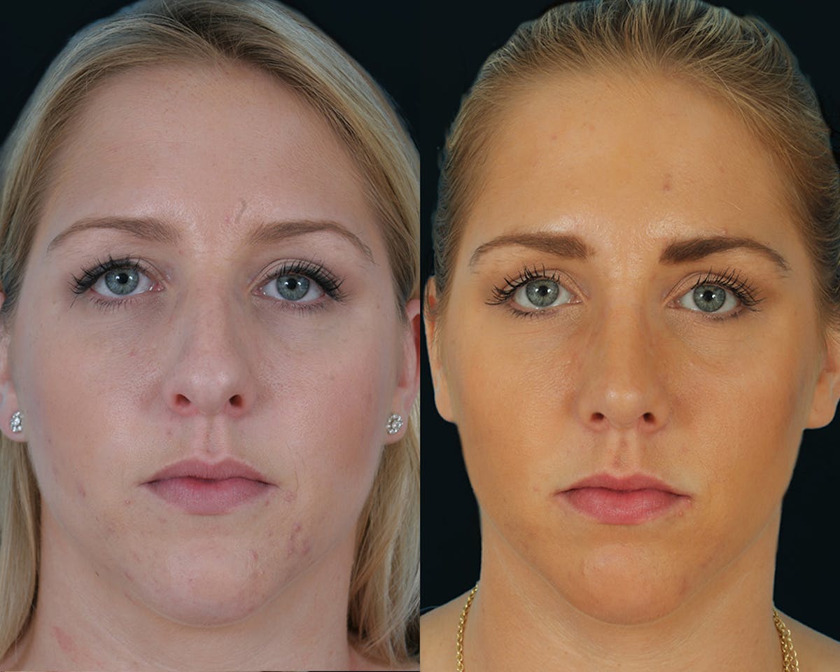 Rhinoplasty Before & After Gallery - Patient 403995 - Image 2