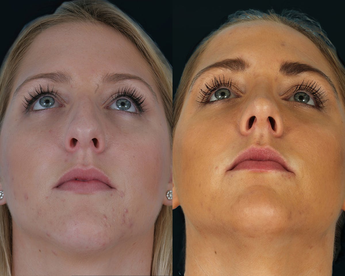 Rhinoplasty Before & After Gallery - Patient 403995 - Image 5