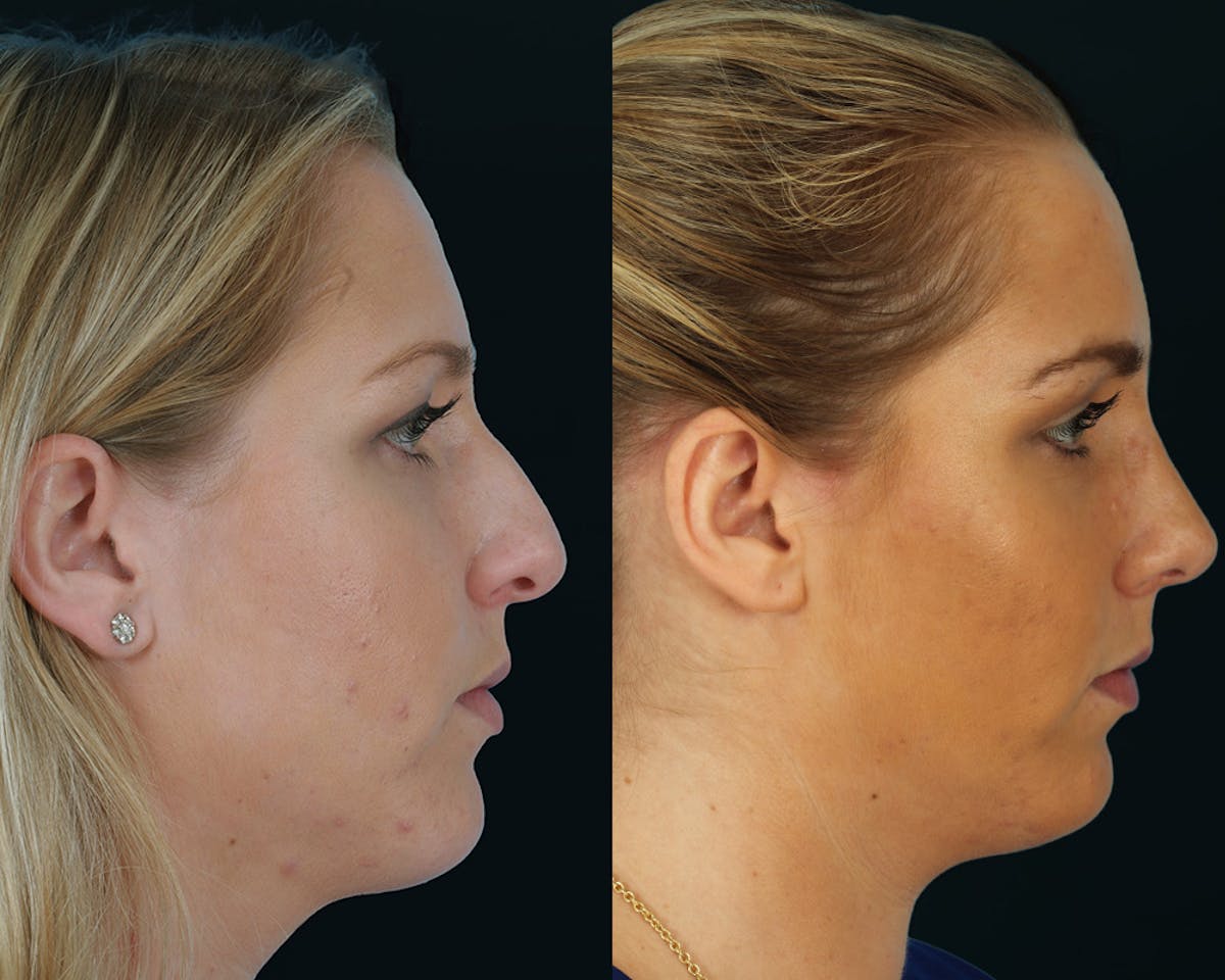Rhinoplasty Before & After Gallery - Patient 403995 - Image 4