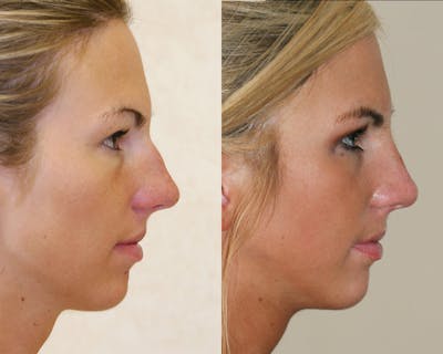 Rhinoplasty Before & After Gallery - Patient 383880 - Image 1