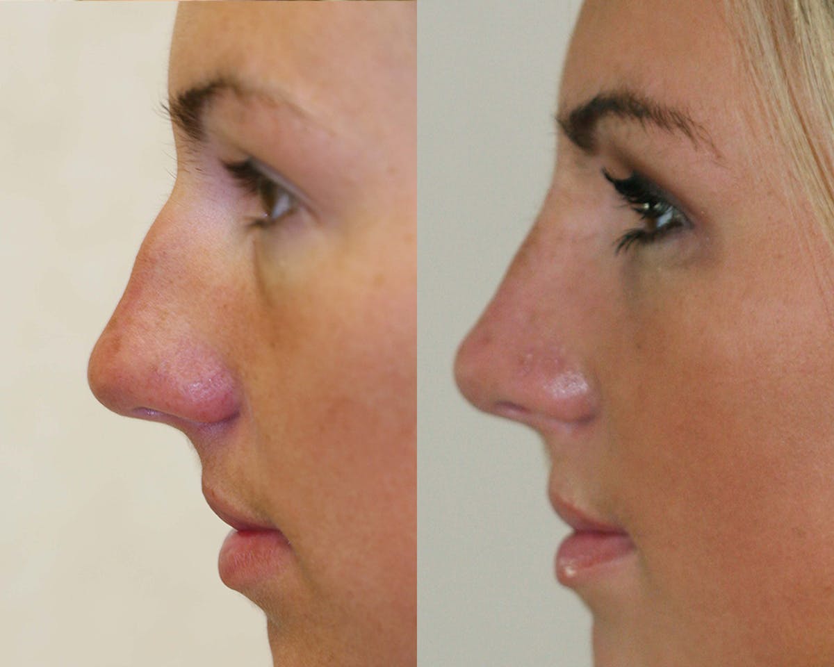 Rhinoplasty Before & After Gallery - Patient 383880 - Image 3