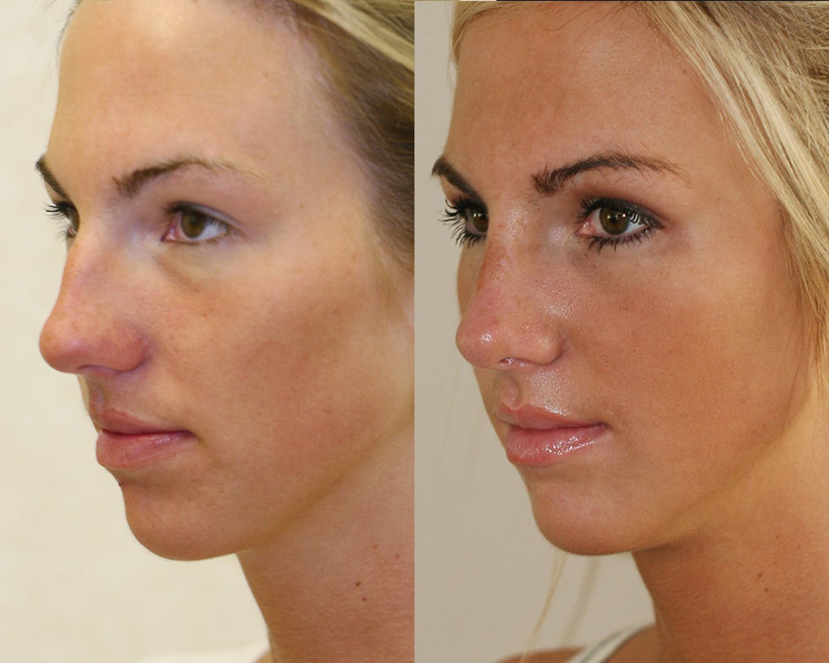 Rhinoplasty Before & After Gallery - Patient 383880 - Image 2