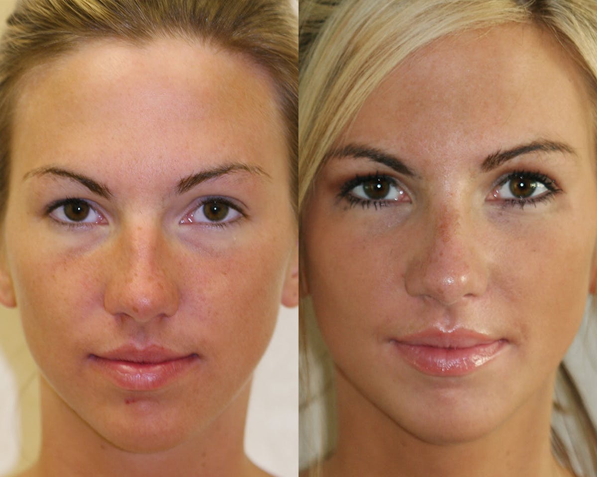 Rhinoplasty Before & After Gallery - Patient 383880 - Image 4
