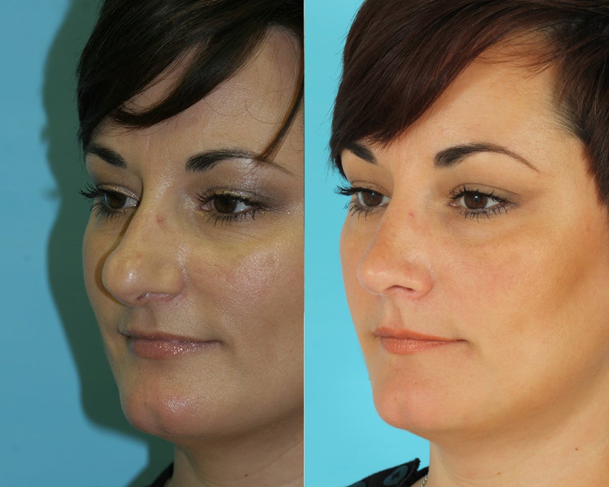 Rhinoplasty Before & After Gallery - Patient 249718 - Image 1