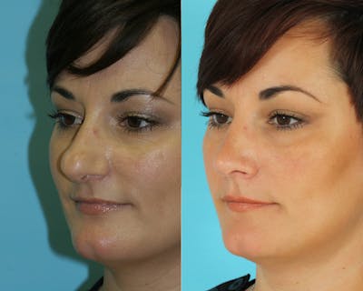 Rhinoplasty Before & After Gallery - Patient 249718 - Image 1