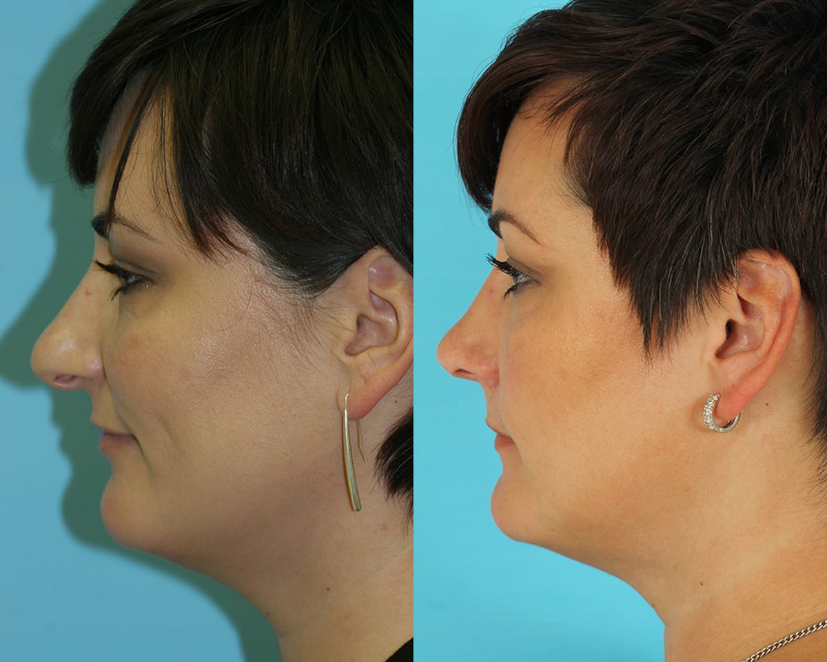 Rhinoplasty Before & After Gallery - Patient 249718 - Image 3