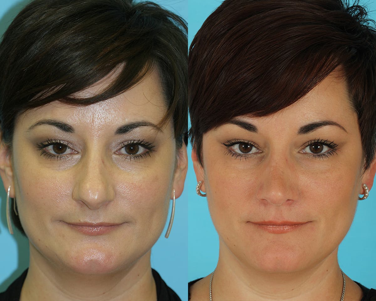 Rhinoplasty Before & After Gallery - Patient 249718 - Image 2