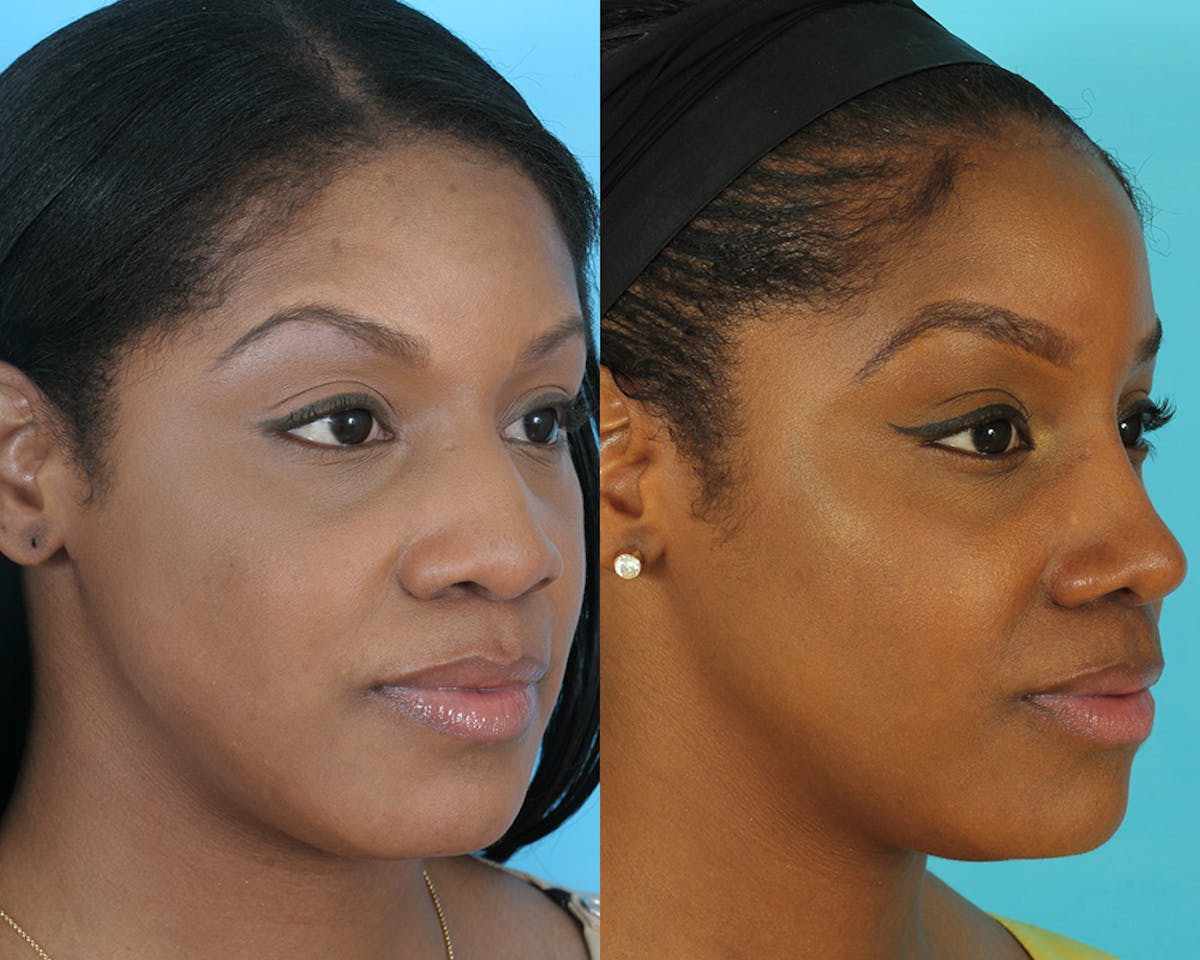 Rhinoplasty Before & After Gallery - Patient 237368 - Image 1