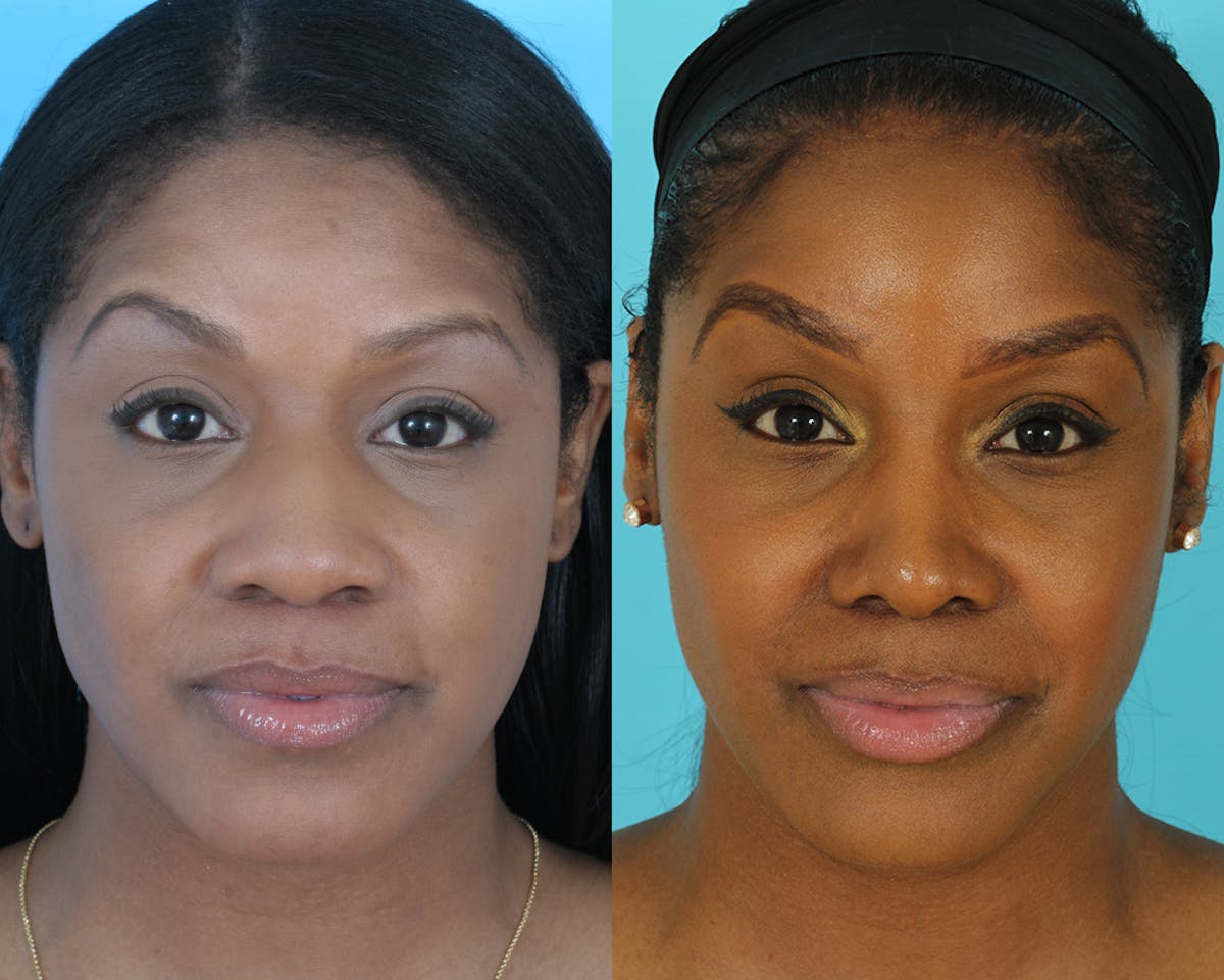 Rhinoplasty Before & After Gallery - Patient 237368 - Image 2