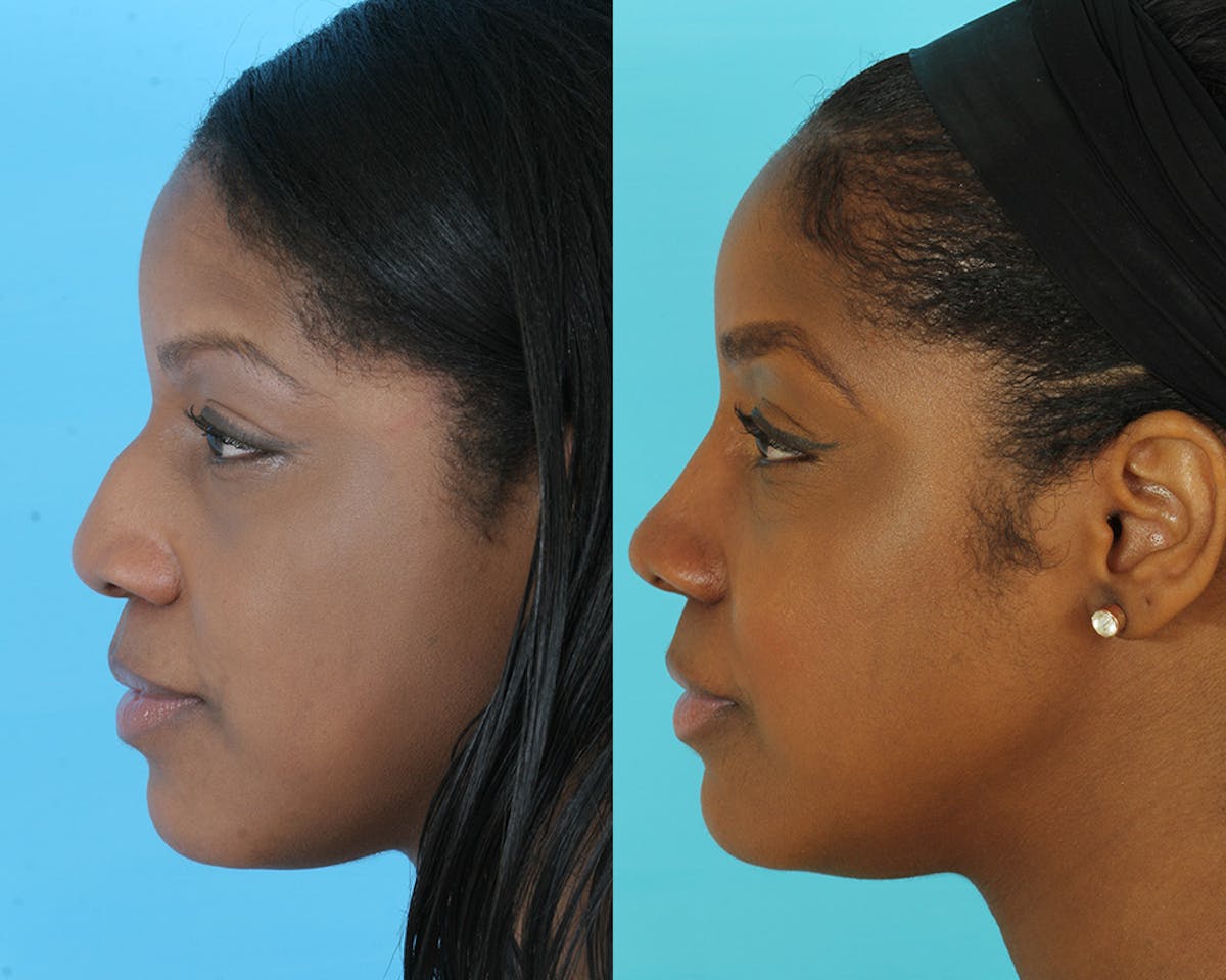 Rhinoplasty Before & After Gallery - Patient 237368 - Image 3